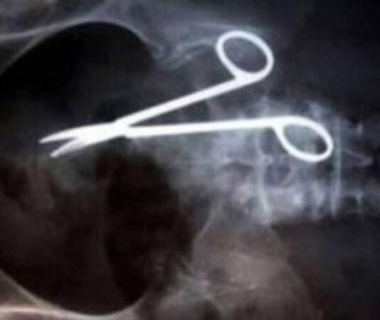 In agonia per anni scopre di avere delle forbici nello stomaco