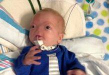 Neonato nasce senza naso, 1 probabilità ogni 197milioni