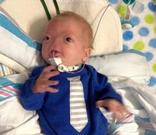 Neonato nasce senza naso, 1 probabilità ogni 197milioni