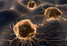 Calabria e cancro, 410 i casi di tumore al pancreas nel 2015