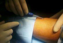 Reggio Calabria, servizio diabetologia: applicato sensore controllo glicemia