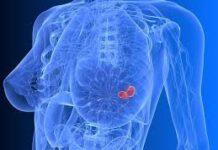 Tumori: 373.300 nuovi casi nel 2018, 4.300 in più del 2017