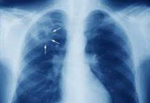 Tubercolosi, parla l’esperto OMS: “I migranti si portano dietro l’infezione che le condizioni del viaggio fa esplodere”