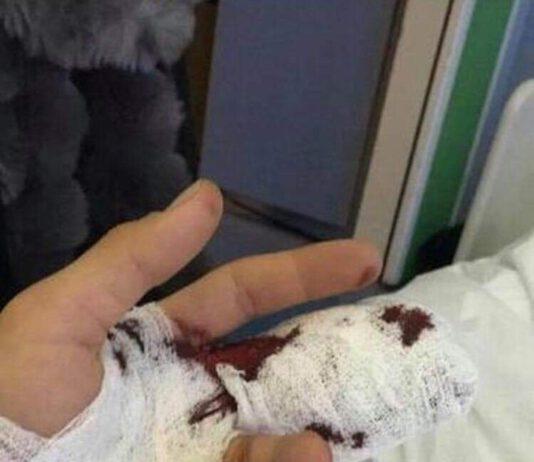 Egiziano stacca dito a morsi ad agente di Palmi