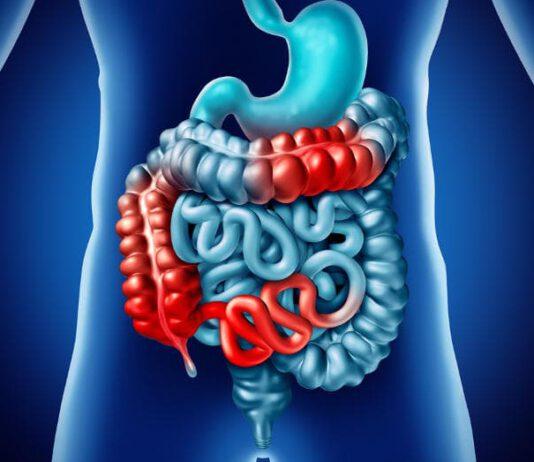 Malattia di Crohn e colite ulcerosa: sono le donne a rischiare di più, tra fertilità e desiderio materno
