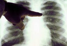 Tumore polmone, un nuovo farmaco per combatterlo