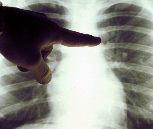 Tumore polmone, un nuovo farmaco per combatterlo