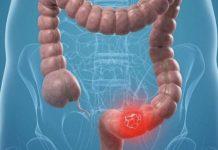 Tumore colon retto – pazienti guariti con anticorpi monoclonali