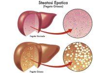 Fegato grasso, colpito il 25% della popolazione. Più a rischio obesi e diabetici. Nuovi studi italiani migliorano prevenzione, diagnosi e follow up