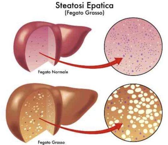 Fegato grasso, colpito il 25% della popolazione. Più a rischio obesi e diabetici. Nuovi studi italiani migliorano prevenzione, diagnosi e follow up