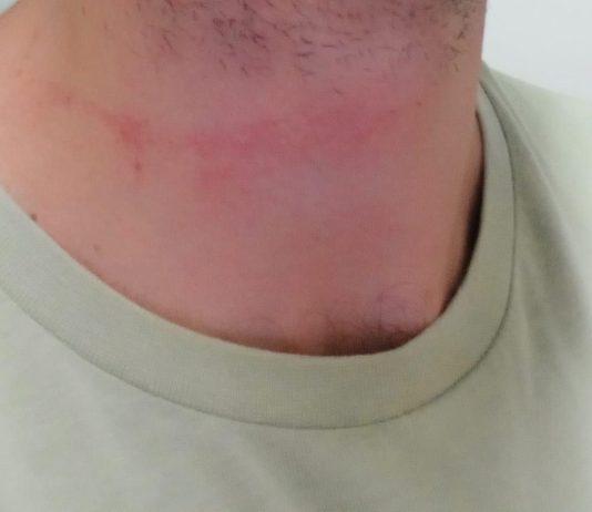 Infermiere di Rosarno aggredito in carcere da detenuto