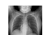 Complesso intervento in urgenza della Chirurgia Toracica del GOM: rimosso cacciavite odontoiatrico dal bronco