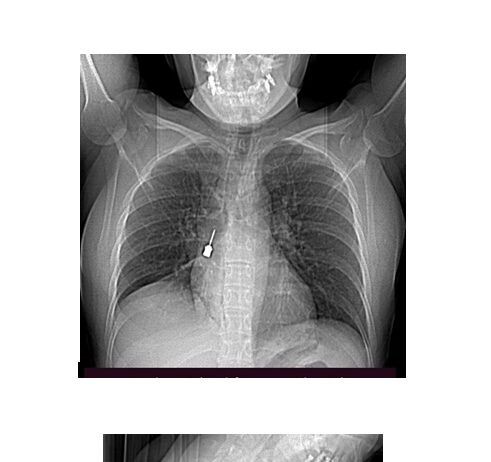Complesso intervento in urgenza della Chirurgia Toracica del GOM: rimosso cacciavite odontoiatrico dal bronco