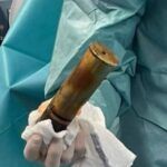 Tolosa, arriva in ospedale con una bomba nel retto: scatta l’allarme e intervengono gli artificieri