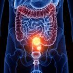 In Calabria il tumore del colon-retto colpisce di più: pochi cittadini fanno lo screening