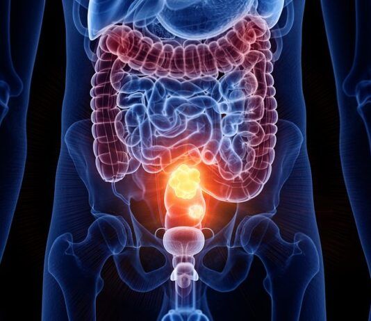 In Calabria il tumore del colon-retto colpisce di più: pochi cittadini fanno lo screening